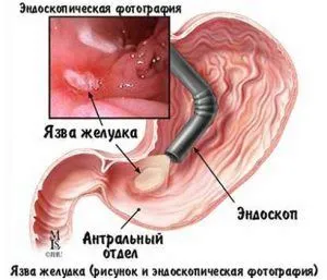 як лікувати шлунок у дітей