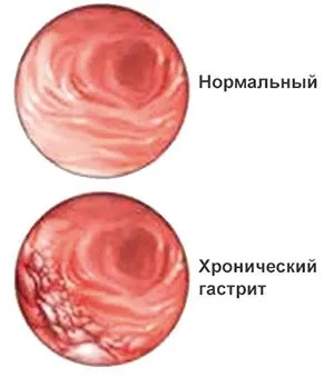 хронічний гастрит