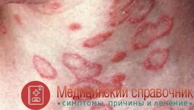 баланопостит фото лікування чоловік дитина кандидозний