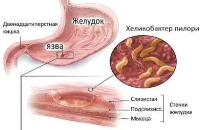 як лікувати хелікобактер пілорі у дорослих