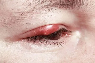 халязион верхній повіку видалення лікування лікувати запалення метод використовувати видалення ячмінь запалитися заліза лазерний офтальмолог