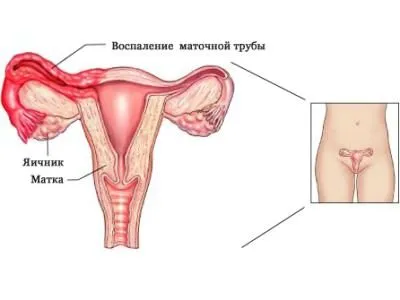 як лікувати гострий ендометрит