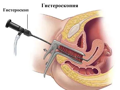як лікувати гострий ендометрит