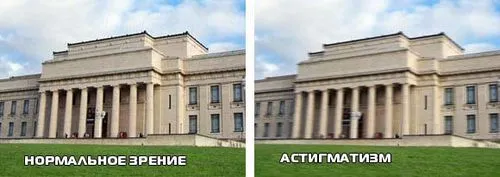 як лікувати вроджений астигматизм