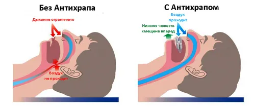 як вилікувати хропіння під час сну