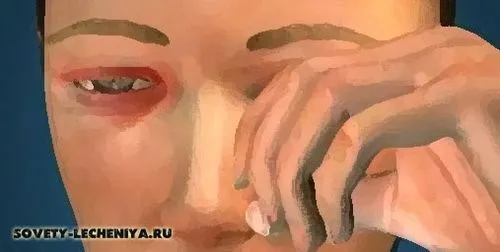 Блефарит - причини, симптоми, ознаки, види та лікування чим краще лікувати блефарит