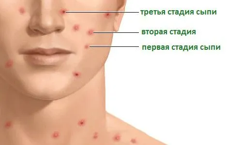 як лікувати вітрянку в 20 років