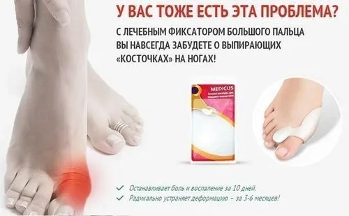 артроз гомілковостопного суглоба причини симптоми лікування