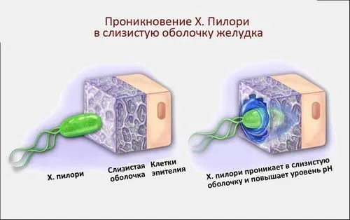 як лікувати хелікобактер пілорі