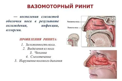 як лікувати вазомоторний риніт в домашніх умовах
