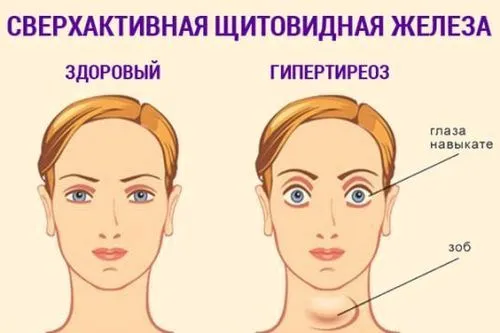 як лікувати вузловий зоб щитовидної залози