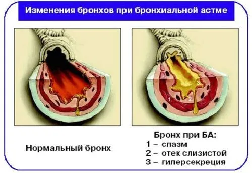 як лікувати атопічний астму