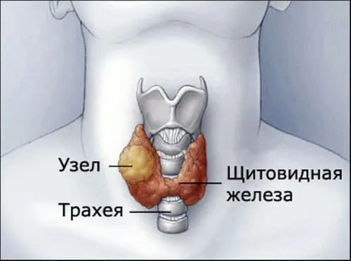 як лікувати вузловий зоб щитовидної залози