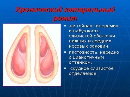 лікувати хронічний риніт домашніх умовах