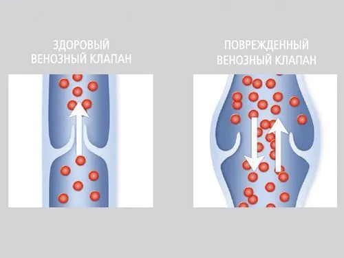 варикоз яєчок у чоловіків наслідки варикозне розширення вен малого таза в паху