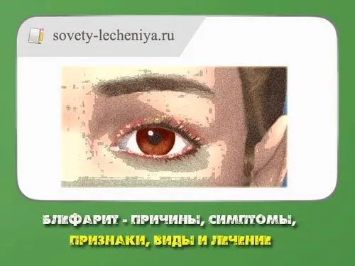 Блефарит - причини, симптоми, ознаки, види та лікування чим краще лікувати блефарит