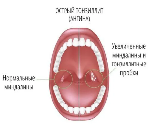 як лікувати тонзиліт у маленьких дітей