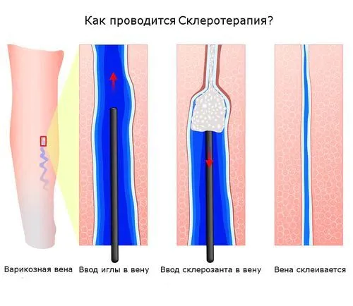 варикоз яєчок у чоловіків наслідки варикозне розширення вен малого таза в паху