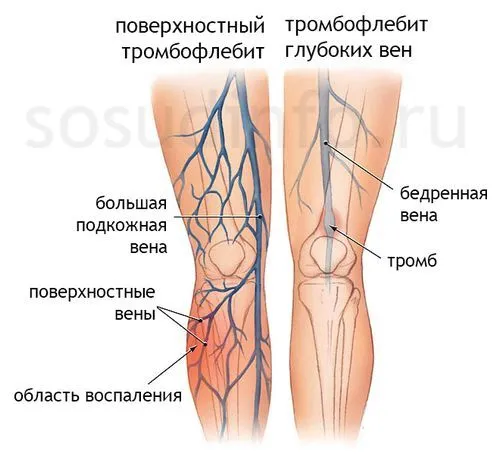 Внутрішній варикоз: види, симптоми, лікування захворювання ознаки