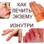 як лікувати екзему зсередини
