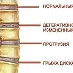 ефективне народний засіб від геморою лікування в домашніх умовах чай як лікувати позбутися