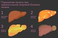 як лікувати печінку при діабеті