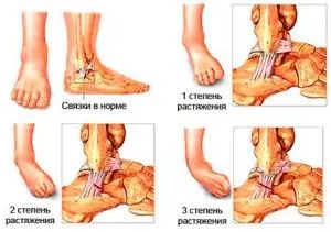 Що робити якщо підвернув ногу лікувати підвернуту ногу
