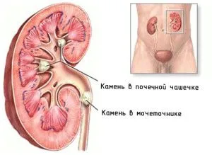 як лікувати в нирках каміння