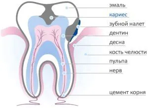 глибокий карієс лікування