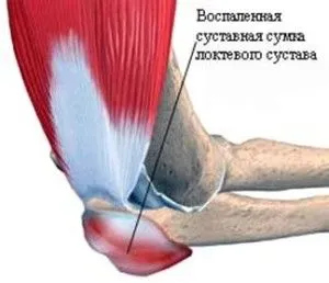 як лікувати бурсит ліктя будинку