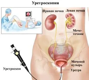 як лікувати в нирках каміння