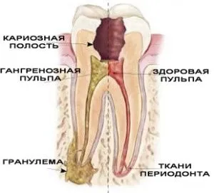 глибокий карієс