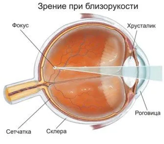 як лікувати слабку короткозорість