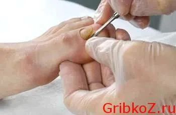 чорний почорніти стадій рости грибок ніготь нога палець врости