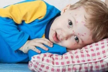 як лікувати стрептодермії у дітей