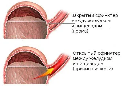 як позбутися від печії в домашніх умовах