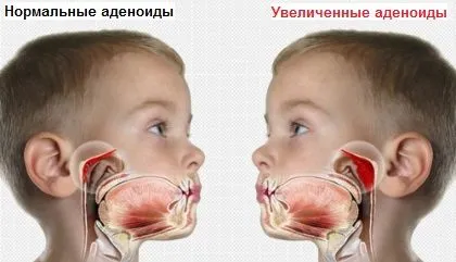 золотистий стафілокок