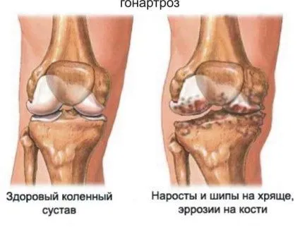 гонартроз