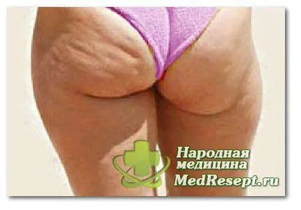 целюліт причини