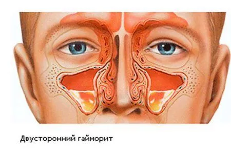 хронічний нежить і чхання