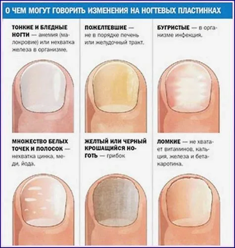 як вилікувати хворий ніготь на руці
