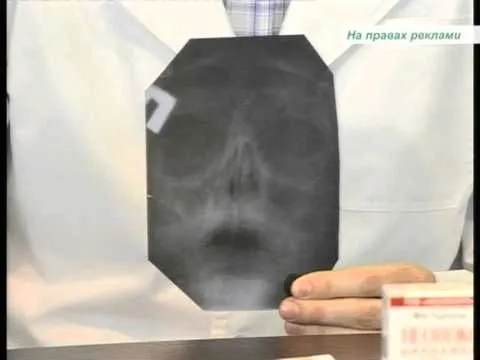 хронічний гайморит чим небезпечний