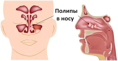 поліпи в носі фото