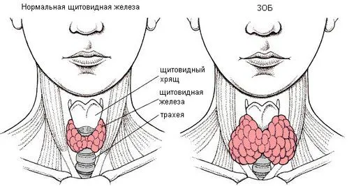як лікувати змішаний зоб