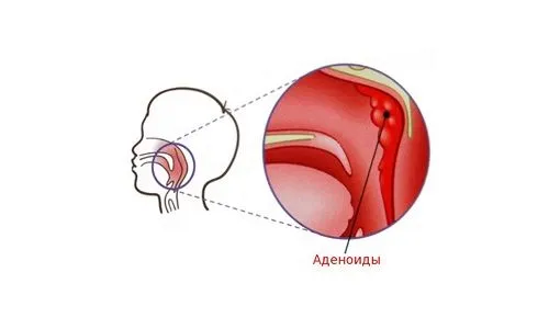 Гнійний аденоидит у дітей: причини, симптоми, лікування як лікувати гнійні аденоїди