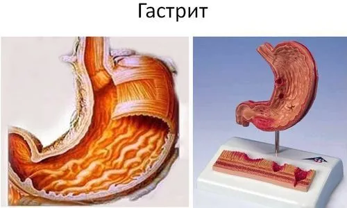 як лікувати гіпоацидний гастрит