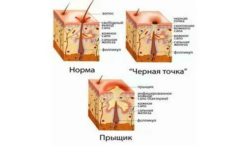 як вилікувати прищі на попі