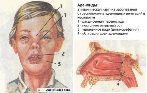 золотистий стафілокок