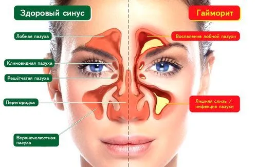до чого призводить хронічний гайморит