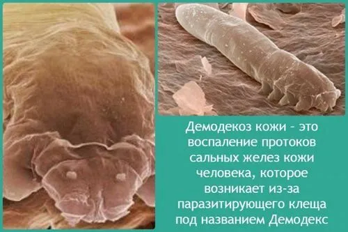як лікувати демодекоз у дітей